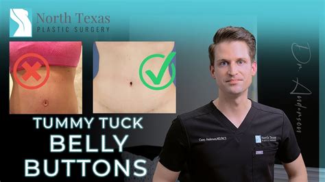 Other post-op Abdominoplasty complications can be subdivided. . White inside belly button after tummy tuck
